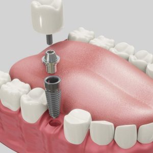 https://www.ino.cl/web/wp-content/uploads/2020/05/Dental-Implantology_edited_0-e1675696018784-300x300.jpg
