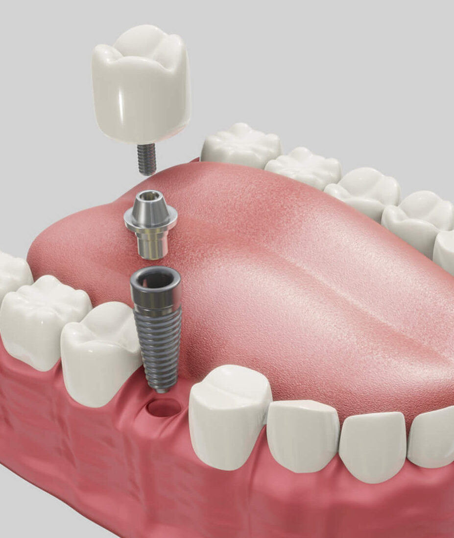 Dental Implantology_edited_0 https://www.ino.cl/web/wp-content/uploads/2020/05/Dental-Implantology_edited_0-e1675696018784.jpg