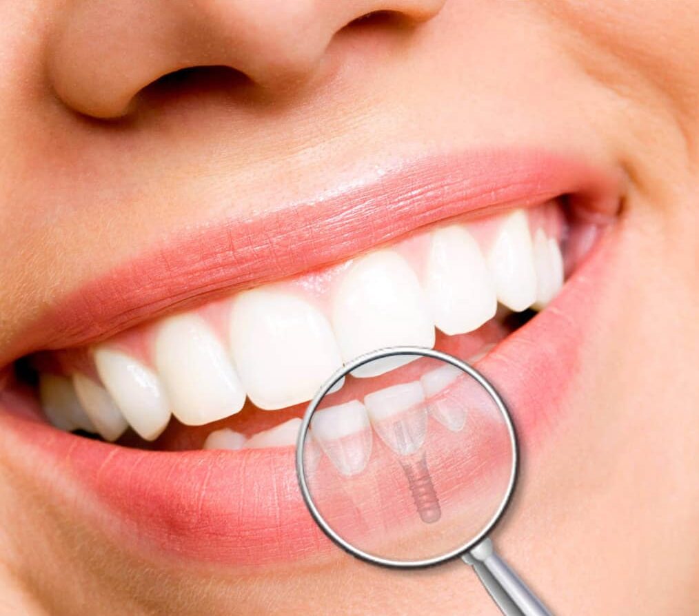 implantologia https://www.ino.cl/web/wp-content/uploads/2020/05/implantologia-e1675696599300.jpg