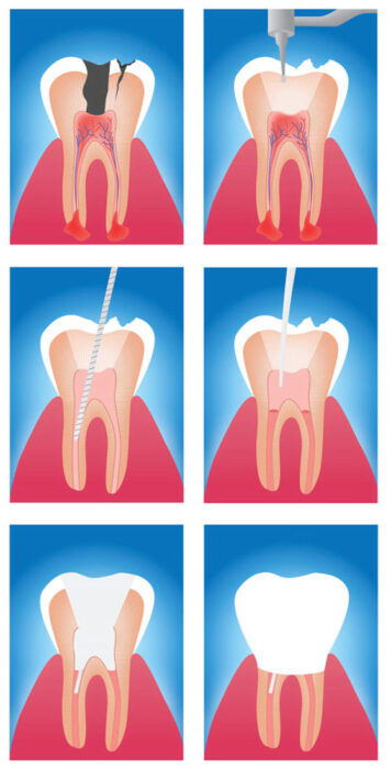 https://www.ino.cl/web/wp-content/uploads/2023/02/endodoncia-raices-e1675699133703.jpg