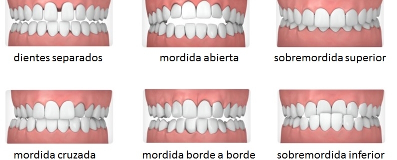 Maloclusión Dental - Instituto Nacional de Ortodoncia
